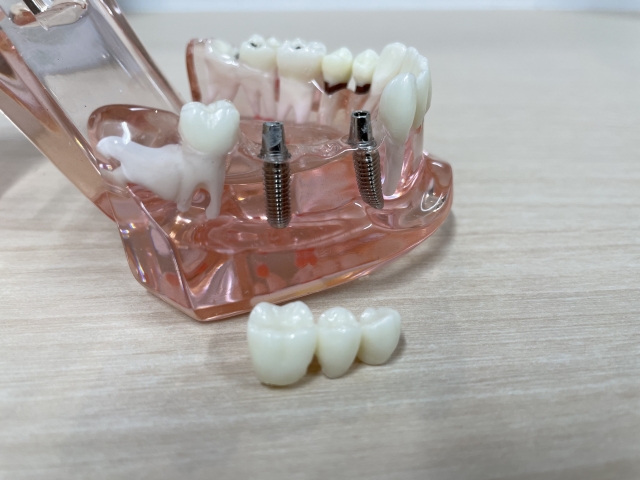 インプラントは何歳まで可能？