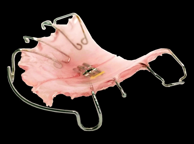 床矯正ってどんな治療？マルチブラケットとの違いは？