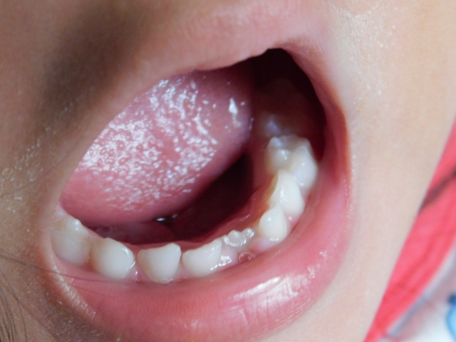 子どもの歯並びの異常は見分けにくいから「あれ？」と感じたら専門家に相談を