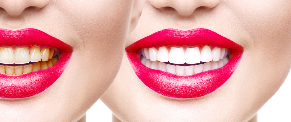 美人度アップ！ホワイトニングの基礎知識